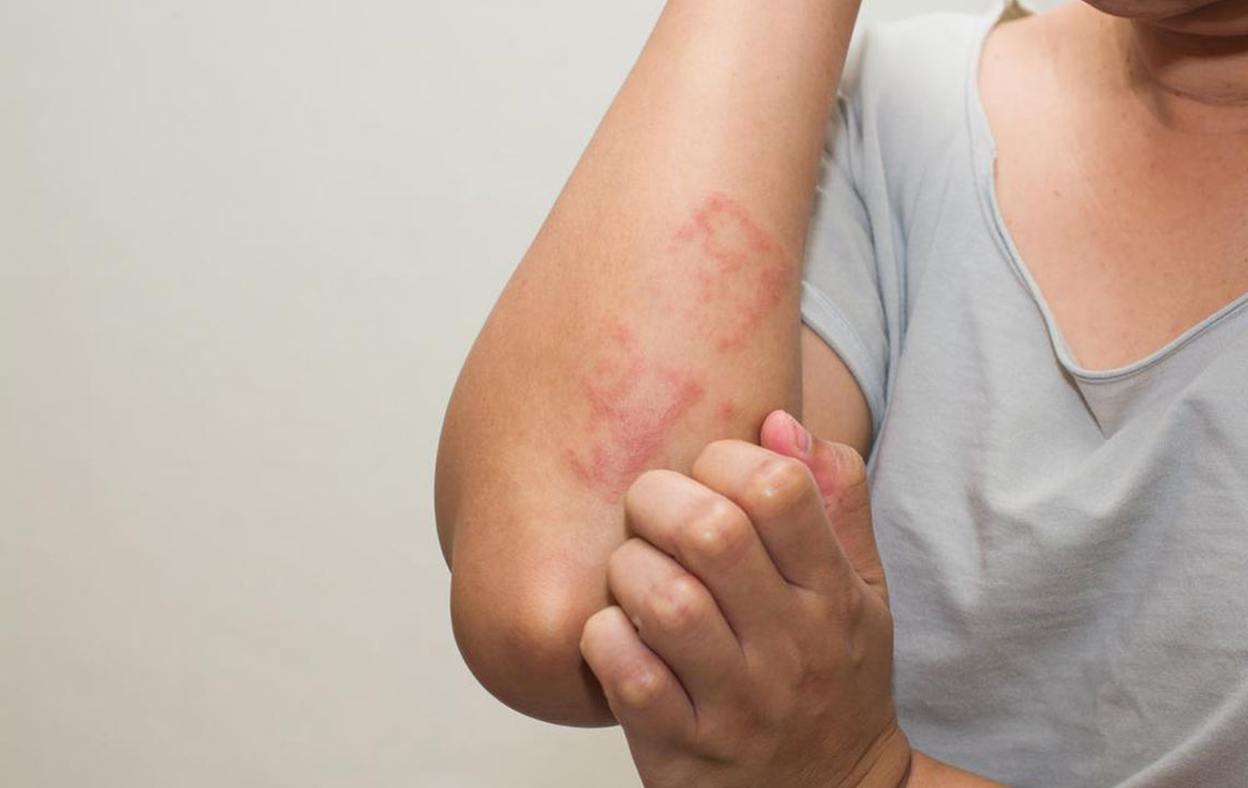 Lupus Skin Rash – Symptoms and Treatment